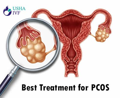 Best Treatment for PCOS or PCOD