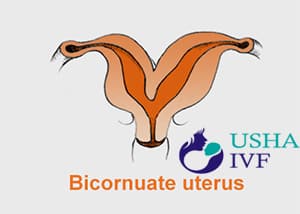 Unicornuate or Bicornuate Uterus and IVF