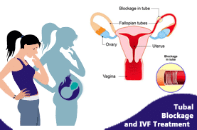 Tubal Blockage and IVF Treatment