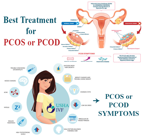 pcos or pcod